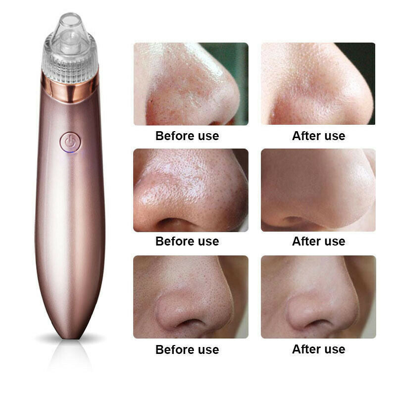 Electric Blackhead Remover – Pore Vacuum & Face Cleanser