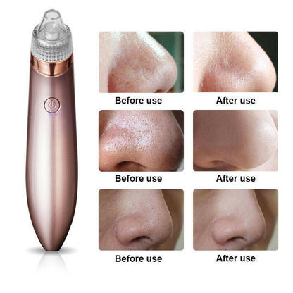 Electric Blackhead Remover – Pore Vacuum & Face Cleanser